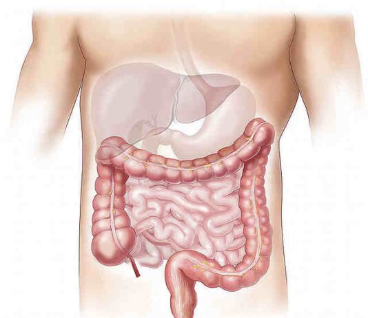 Sintomi morbo di crohn