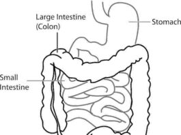 diverticolite