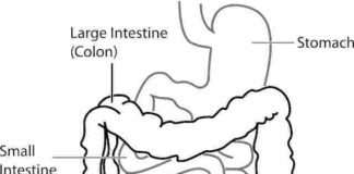 diverticolite