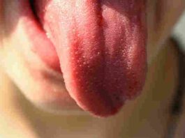 macroglossia sintomi